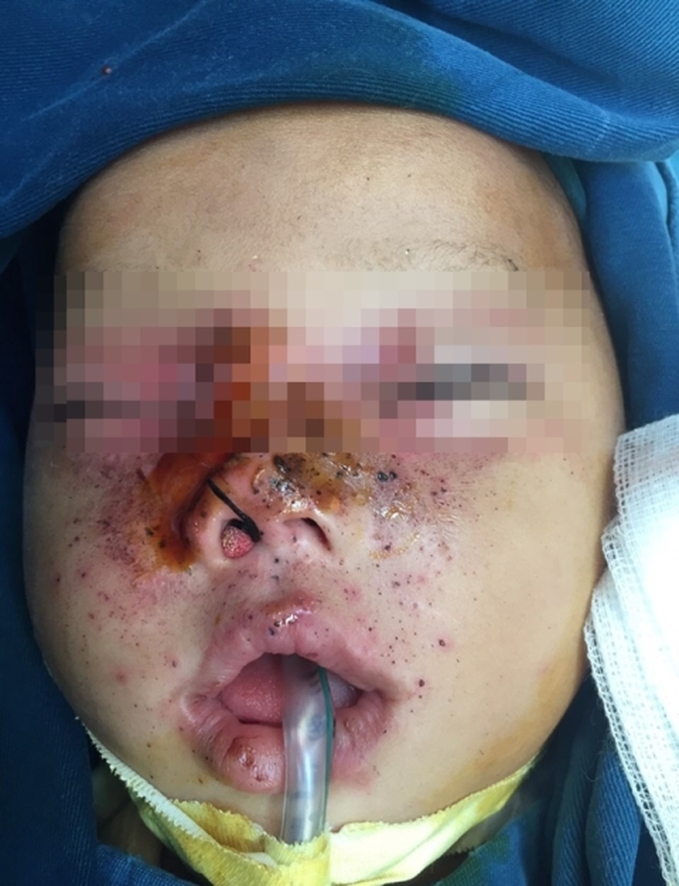 Hãi hùng bé 9 tháng bị anh trai bắn 10 viên đạn chì vào giữa mặt - 1 Hãi hùng bé 9 tháng bị anh trai bắn 10 viên đạn chì vào giữa mặt - 1
