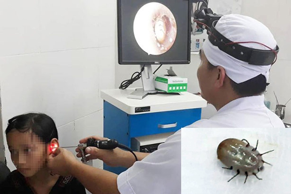 Ve chó chui vào tai, cắn bé gái 10 tuổi đến hoảng loạn - 1 Ve chó chui vào tai, cắn bé gái 10 tuổi đến hoảng loạn - 1