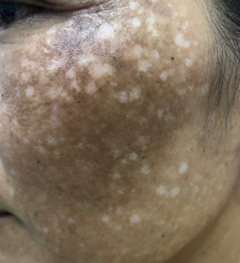 Lời khuyên của bác sĩ chuyên khoa da liễu để chữa nám da hiệu quả - 1 Lời khuyên của bác sĩ chuyên khoa da liễu để chữa nám da hiệu quả - 1