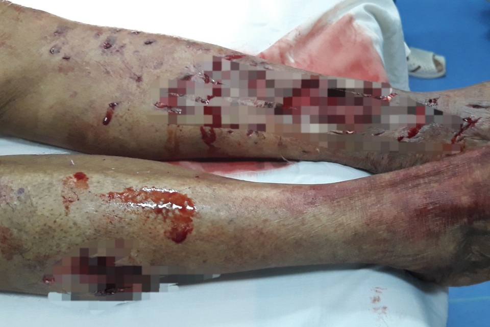 Cụ ông 93 tuổi bị chó nhà cắn nát chân - 1