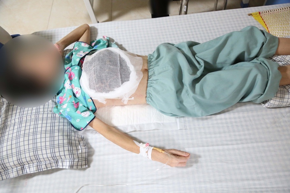 Khối u vỡ chảy mủ, nhiễm độc sau khi chữa ở thầy lang - 1 Khối u vỡ chảy mủ, nhiễm độc sau khi chữa ở thầy lang - 1