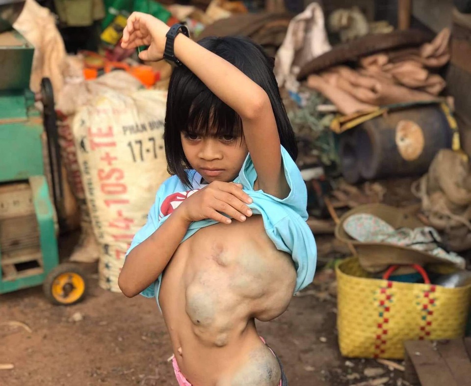 Giải cứu bé gái mang khối bướu chiếm 1/3 cơ thể - 1 Giải cứu bé gái mang khối bướu chiếm 1/3 cơ thể - 1