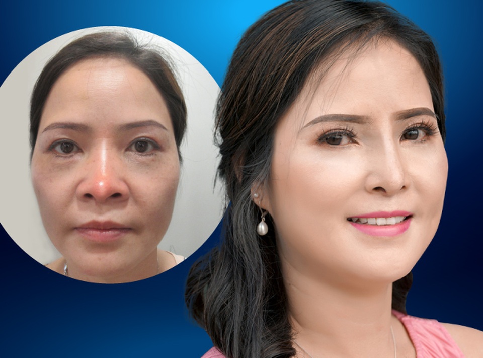Cứu chữa thành công chiếc mũi biến dạng cho nữ Việt kiều - 1 Cứu chữa thành công chiếc mũi biến dạng cho nữ Việt kiều - 1