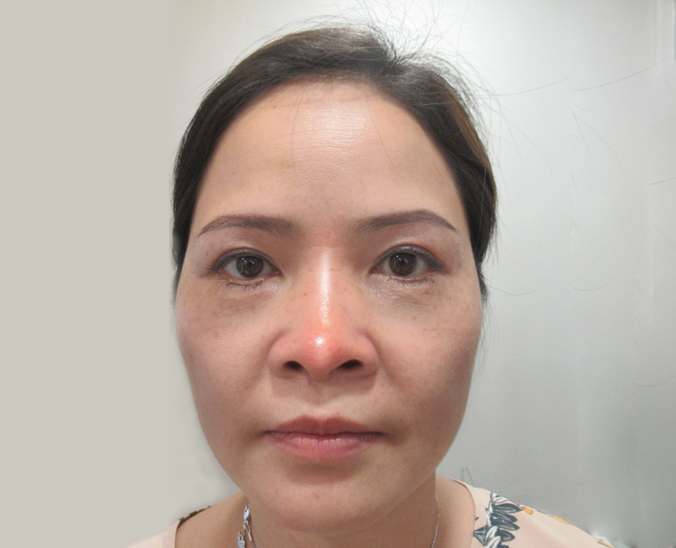 Cứu chữa thành công chiếc mũi biến dạng cho nữ Việt kiều - 2 Cứu chữa thành công chiếc mũi biến dạng cho nữ Việt kiều - 2