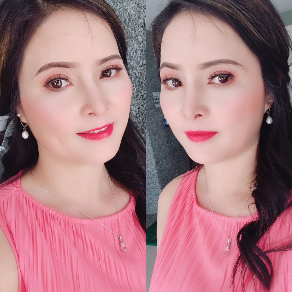 Cứu chữa thành công chiếc mũi biến dạng cho nữ Việt kiều - 5 Cứu chữa thành công chiếc mũi biến dạng cho nữ Việt kiều - 5