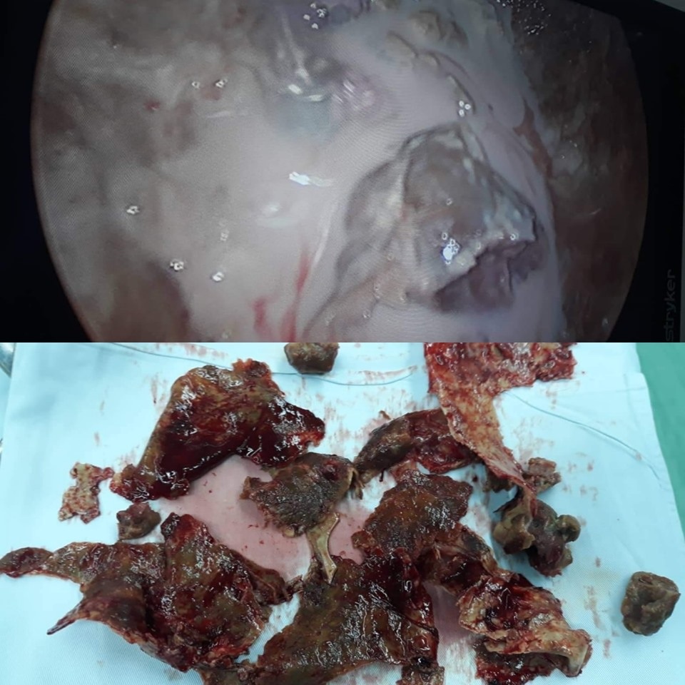 Điều trị thành công ổ cặn mủ màng phổi cho bệnh nhân người Lào - 1 Điều trị thành công ổ cặn mủ màng phổi cho bệnh nhân người Lào - 1