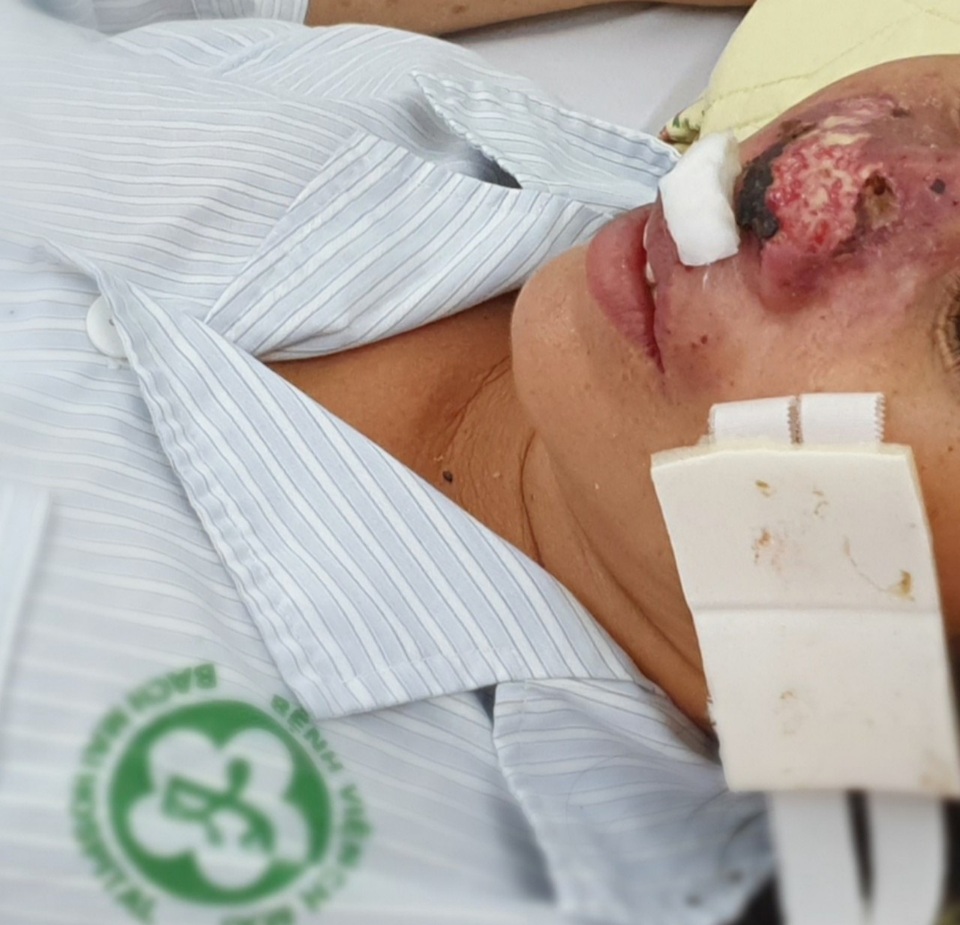 Kỳ lạ vi khuẩn trú trong đất ăn mòn cánh mũi bệnh nhân - 1 Kỳ lạ vi khuẩn trú trong đất ăn mòn cánh mũi bệnh nhân - 1
