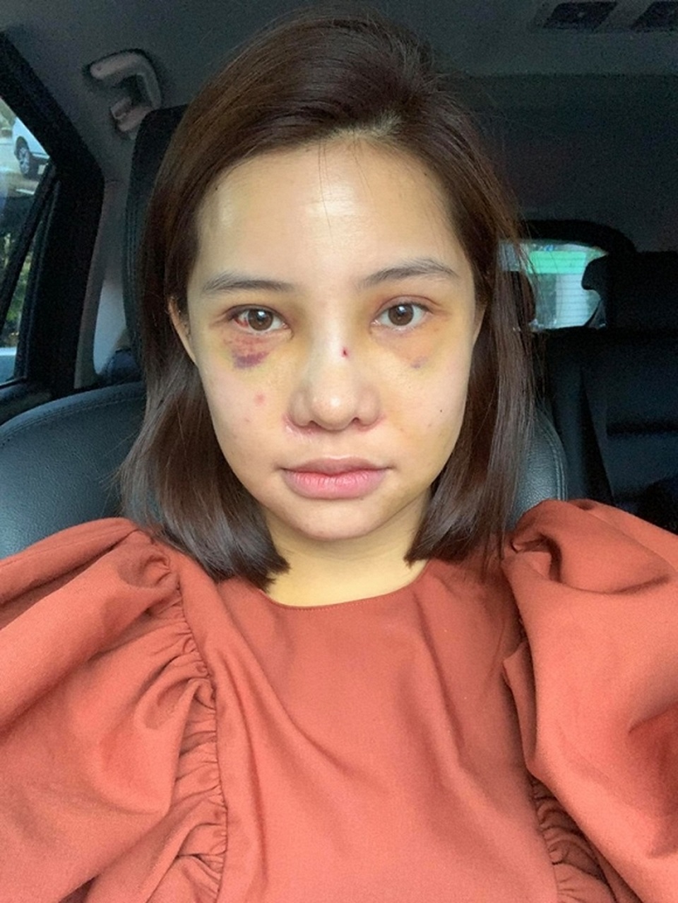 Lưu Đê Ly gây sửng sốt khi công khai quá trình “đập mặt xây lại” - 6 Lưu Đê Ly gây sửng sốt khi công khai quá trình “đập mặt xây lại” - 6