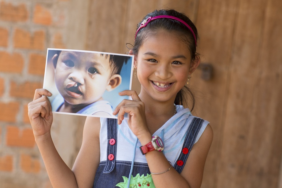 AQUA Việt Nam đồng hành cùng Operation Smile Việt Nam phẫu thuật miễn phí cho trẻ em dị tật vùng hàm mặt - 3 AQUA Việt Nam đồng hành cùng Operation Smile Việt Nam phẫu thuật miễn phí cho trẻ em dị tật vùng hàm mặt - 3