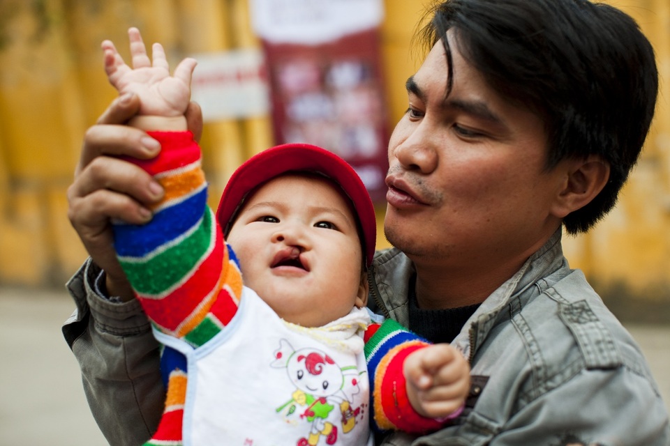 AQUA Việt Nam đồng hành cùng Operation Smile Việt Nam phẫu thuật miễn phí cho trẻ em dị tật vùng hàm mặt - 4 AQUA Việt Nam đồng hành cùng Operation Smile Việt Nam phẫu thuật miễn phí cho trẻ em dị tật vùng hàm mặt - 4