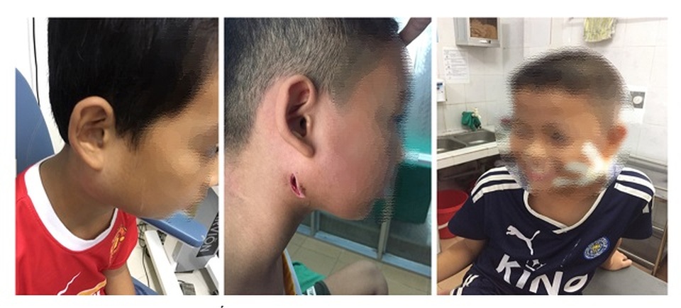3 trẻ tưởng quai bị hoá nhiễm vi khuẩn chết người - 1 3 trẻ tưởng quai bị hoá nhiễm vi khuẩn chết người - 1