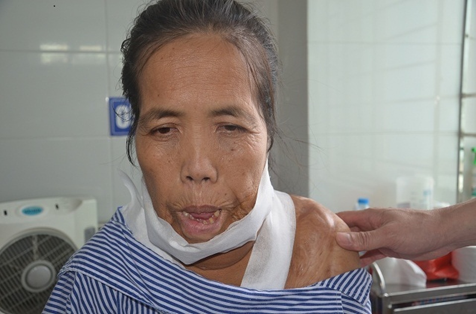 Người đàn bà mang hàm răng “kỳ dị” đã có “khuôn mặt mới” sau ca phẫu thuật - 4 Người đàn bà mang hàm răng “kỳ dị” đã có “khuôn mặt mới” sau ca phẫu thuật - 4