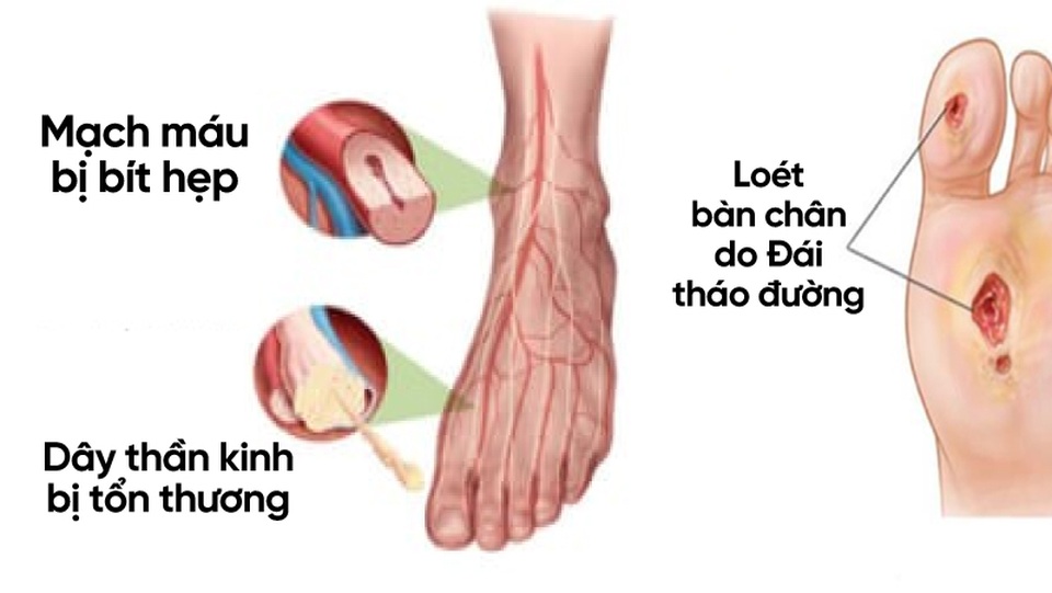 Đái tháo đường: Cách hỗ trợ phòng và giảm tê bì chân tay nguy cơ loét bàn chân - 1 Đái tháo đường: Cách hỗ trợ phòng và giảm tê bì chân tay nguy cơ loét bàn chân - 1