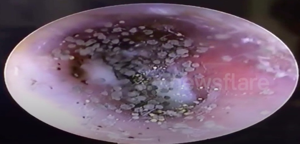 Người phụ nữ mọc hàng trăm ‘cây nấm’ trong tai - 1 Người phụ nữ mọc hàng trăm ‘cây nấm’ trong tai - 1