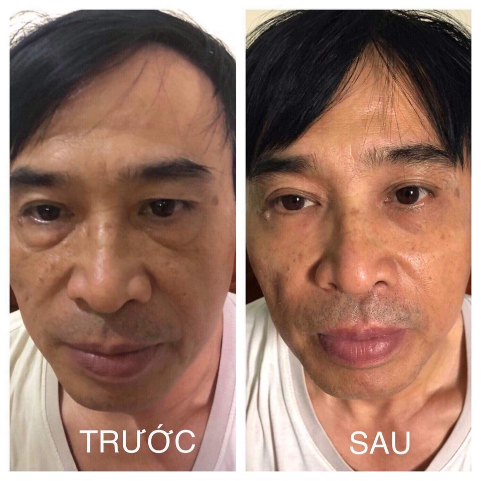 Haduhi xóa tan nỗi lo bọng mắt nếp nhăn chỉ với 2 phút mỗi ngày - 5 Haduhi xóa tan nỗi lo bọng mắt nếp nhăn chỉ với 2 phút mỗi ngày - 5