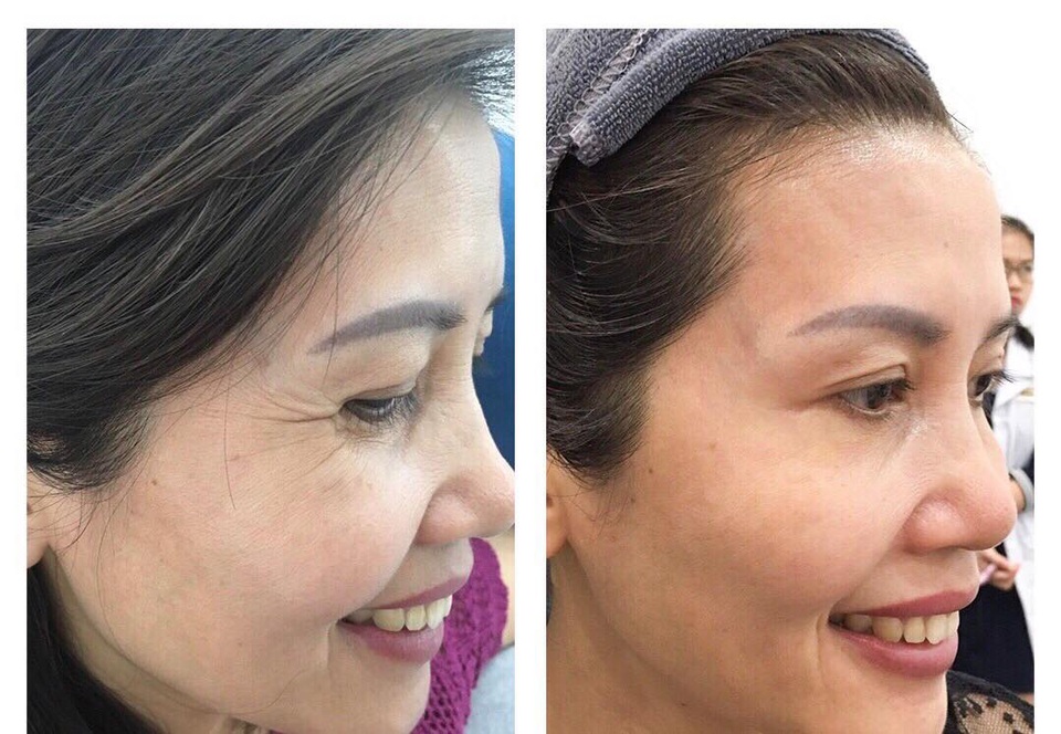 Haduhi xóa tan nỗi lo bọng mắt nếp nhăn chỉ với 2 phút mỗi ngày - 6 Haduhi xóa tan nỗi lo bọng mắt nếp nhăn chỉ với 2 phút mỗi ngày - 6