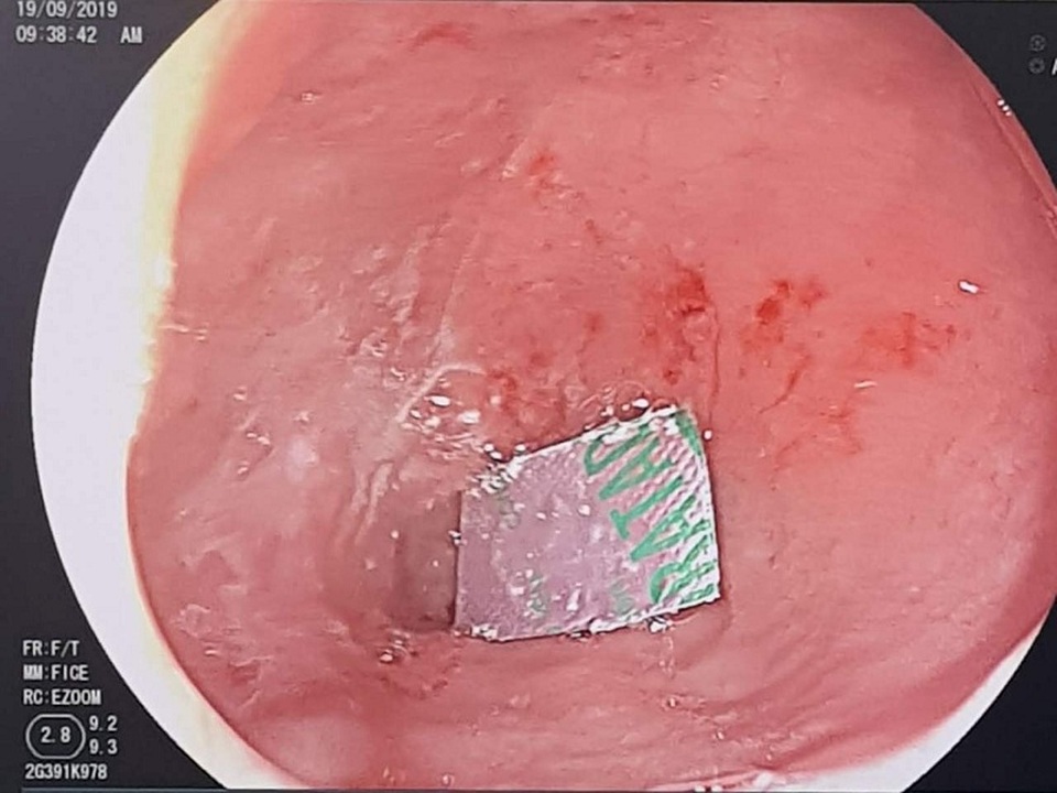 Quên bóc vỉ thuốc trước khi uống, nữ bệnh nhân 65 tuổi phải nhập viện - 1 Quên bóc vỉ thuốc trước khi uống, nữ bệnh nhân 65 tuổi phải nhập viện - 1