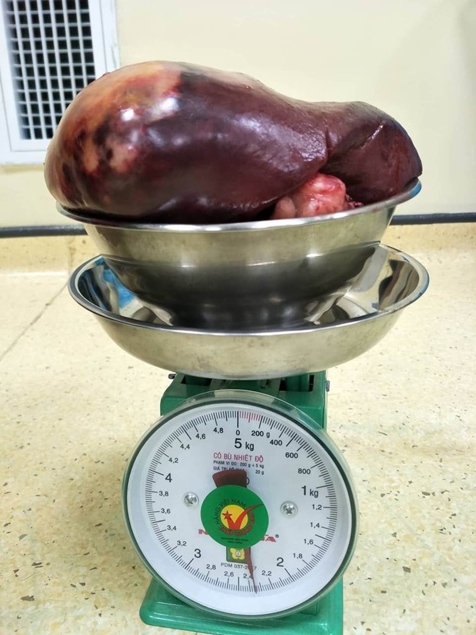 Bác sĩ rùng mình cắt khối u khổng lồ nặng gấp 11 lần trọng lượng của lá lách - 1 Bác sĩ rùng mình cắt khối u khổng lồ nặng gấp 11 lần trọng lượng của lá lách - 1