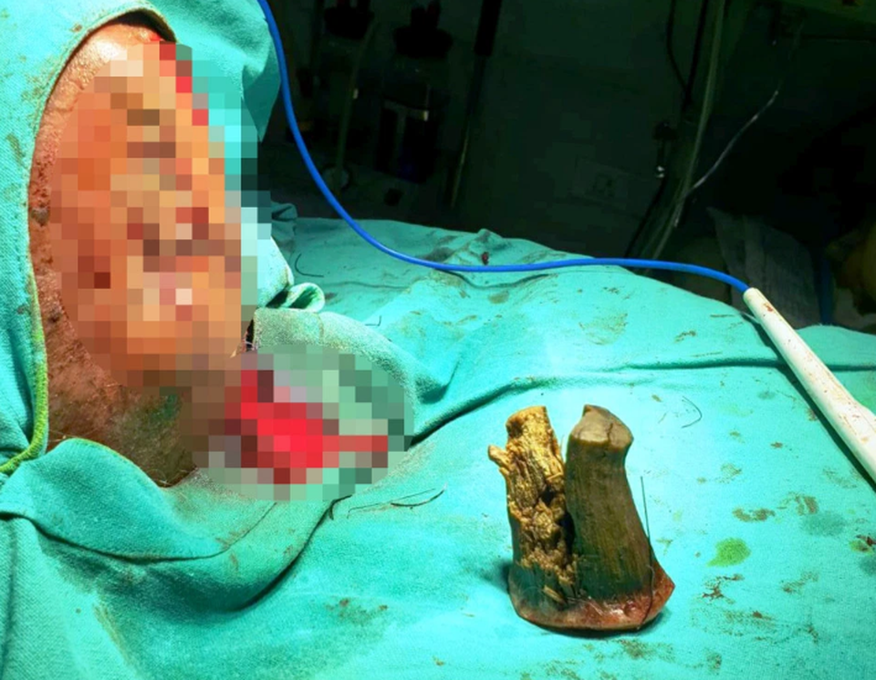 “Sừng quỷ” 10cm mọc ra từ đỉnh đầu cụ ông 74 tuổi - 5 “Sừng quỷ” 10cm mọc ra từ đỉnh đầu cụ ông 74 tuổi - 5
