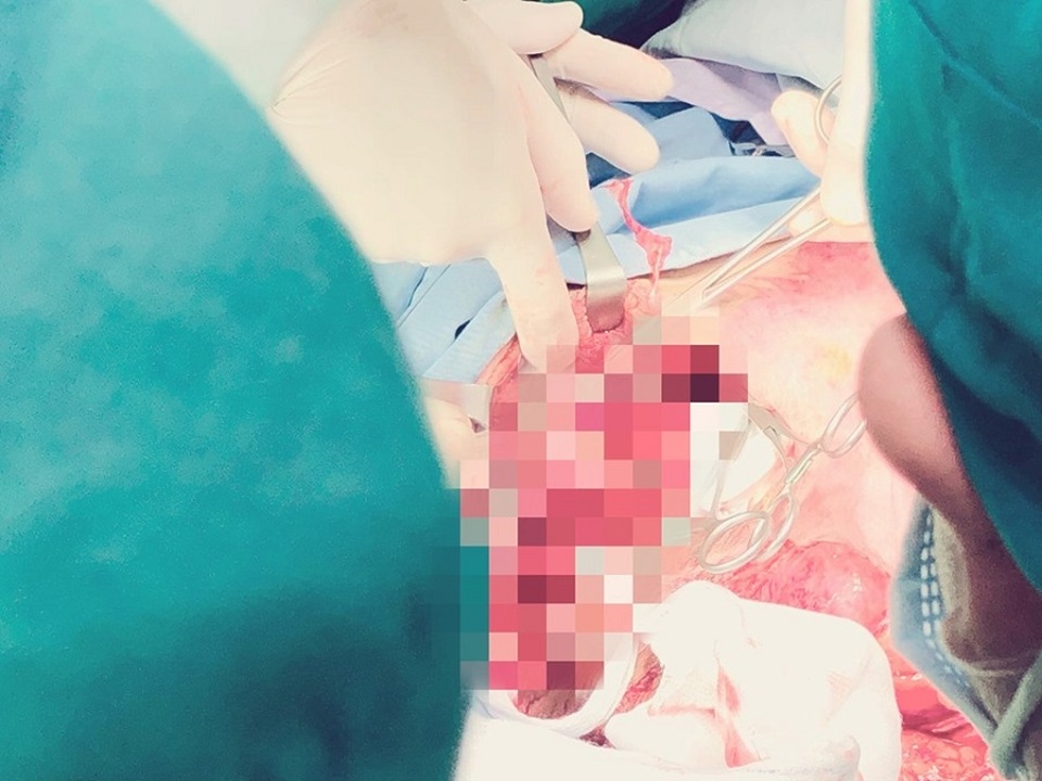 Cứu nữ sinh bị xe tông vỡ toạc vùng chậu sau giờ tan trường - 2