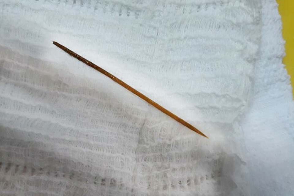 Nuốt phải tăm tre dài 6 cm vào bụng trong lúc ngủ quên - 1