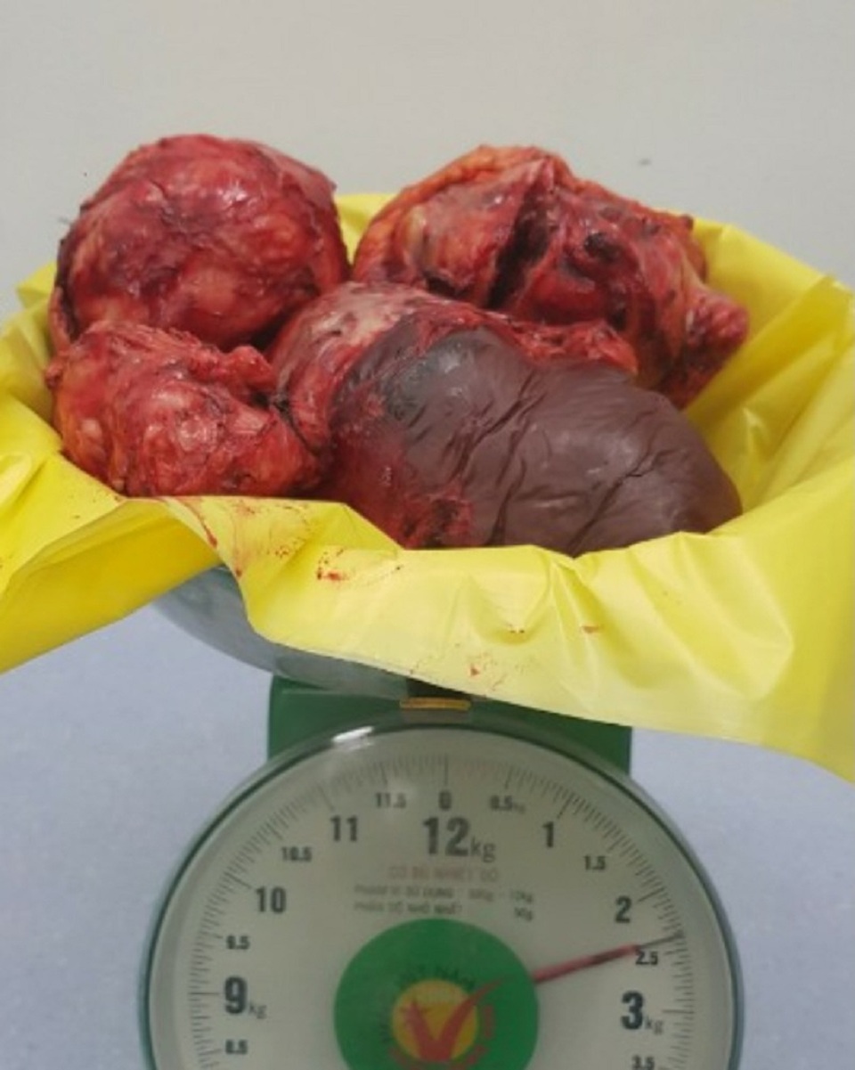 Người đàn ông “mang bầu” 15 năm được bác sĩ giải cứu - 2 Người đàn ông “mang bầu” 15 năm được bác sĩ giải cứu - 2