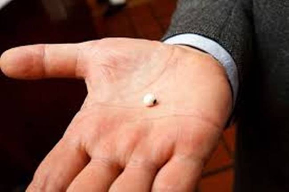 Ăn hàu ở nhà hàng, suýt gẫy răng vì cắn phải 48 viên ngọc trai, giá chục triệu/viên - 2 Ăn hàu ở nhà hàng, suýt gẫy răng vì cắn phải 48 viên ngọc trai, giá chục triệu/viên - 2