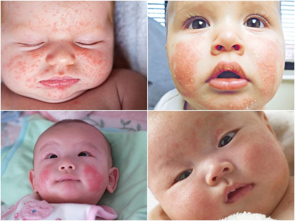 Cách xử lý nhanh và dứt điểm chàm sữa ở trẻ - 1 Cách xử lý nhanh và dứt điểm chàm sữa ở trẻ - 1