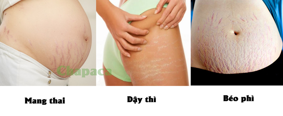 Dầu rạn da Chapaca: Giải pháp đột phá trong phòng và ngăn ngừa rạn da ở phụ nữ - 1