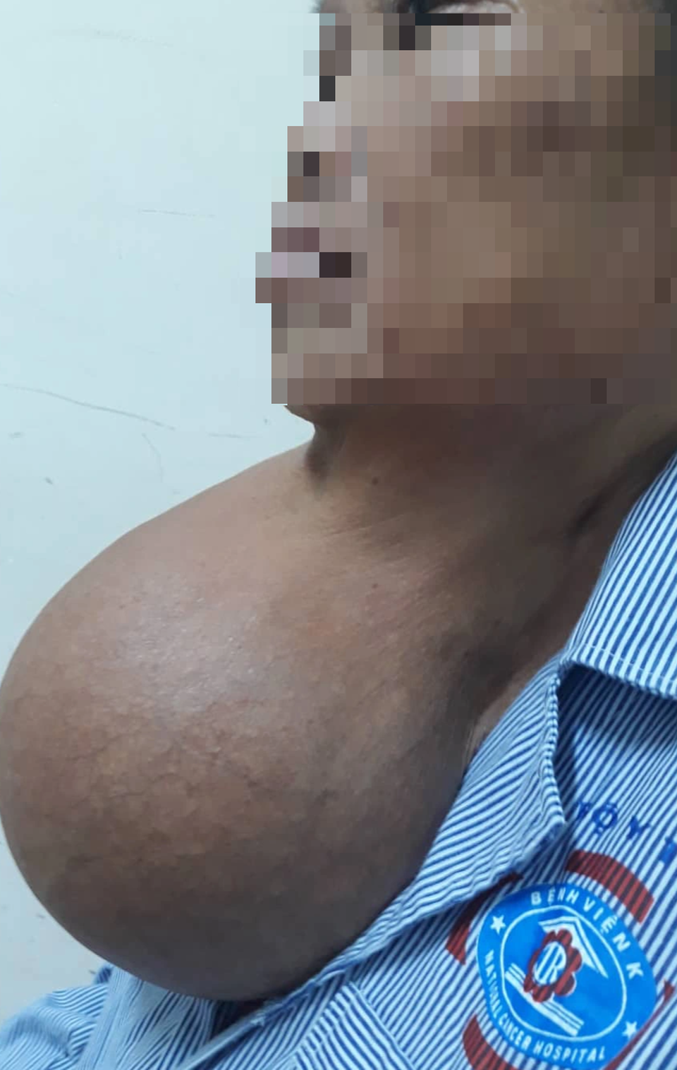 Người phụ nữ được giải thoát sau 20 năm dùng khăn, tay đỡ khối u treo lủng lẳng trước cổ - 1 Người phụ nữ được giải thoát sau 20 năm dùng khăn, tay đỡ khối u treo lủng lẳng trước cổ - 1