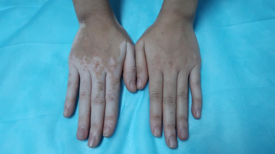 Kỳ lạ cô gái bỗng nhiên đổi màu tay chân vì chữa ra mồ hôi bằng lá trầu không - 1 Kỳ lạ cô gái bỗng nhiên đổi màu tay chân vì chữa ra mồ hôi bằng lá trầu không - 1