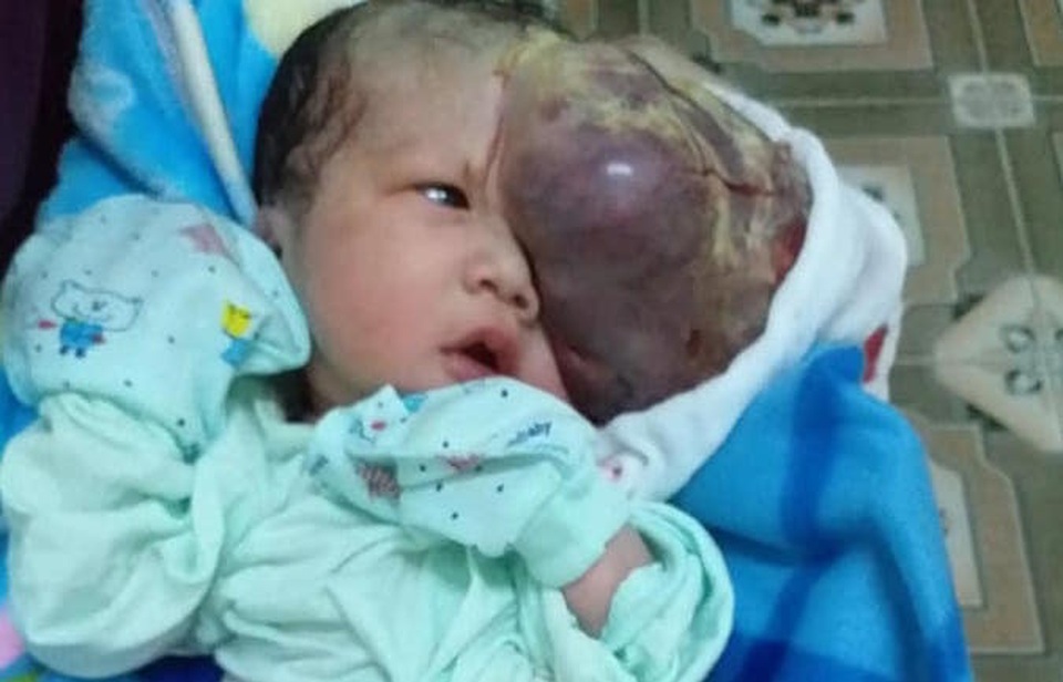 Mẹ chết ngất nhìn con chào đời mang u khủng dị thường trên mặt! - 7 Mẹ chết ngất nhìn con chào đời mang u khủng dị thường trên mặt! - 7