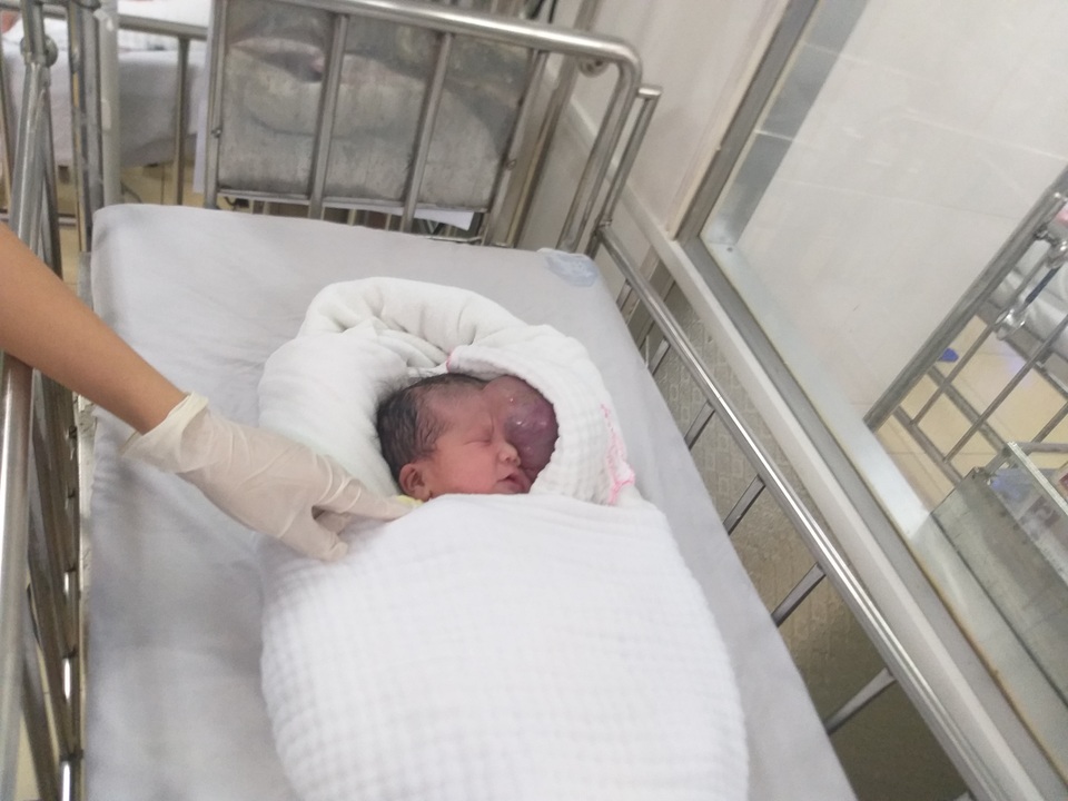 Mẹ chết ngất nhìn con chào đời mang u khủng dị thường trên mặt! - 5 Mẹ chết ngất nhìn con chào đời mang u khủng dị thường trên mặt! - 5