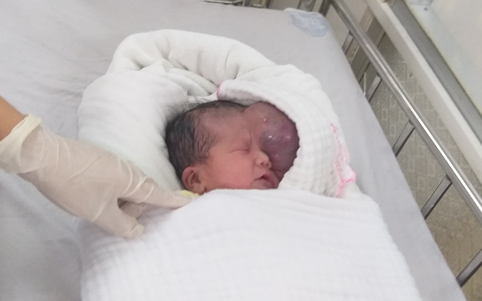 Mẹ chết ngất nhìn con chào đời mang u khủng dị thường trên mặt! - 9 Mẹ chết ngất nhìn con chào đời mang u khủng dị thường trên mặt! - 9