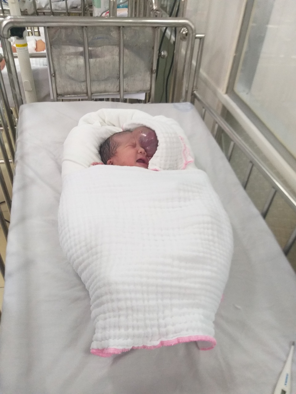 Mẹ chết ngất nhìn con chào đời mang u khủng dị thường trên mặt! - 2 Mẹ chết ngất nhìn con chào đời mang u khủng dị thường trên mặt! - 2