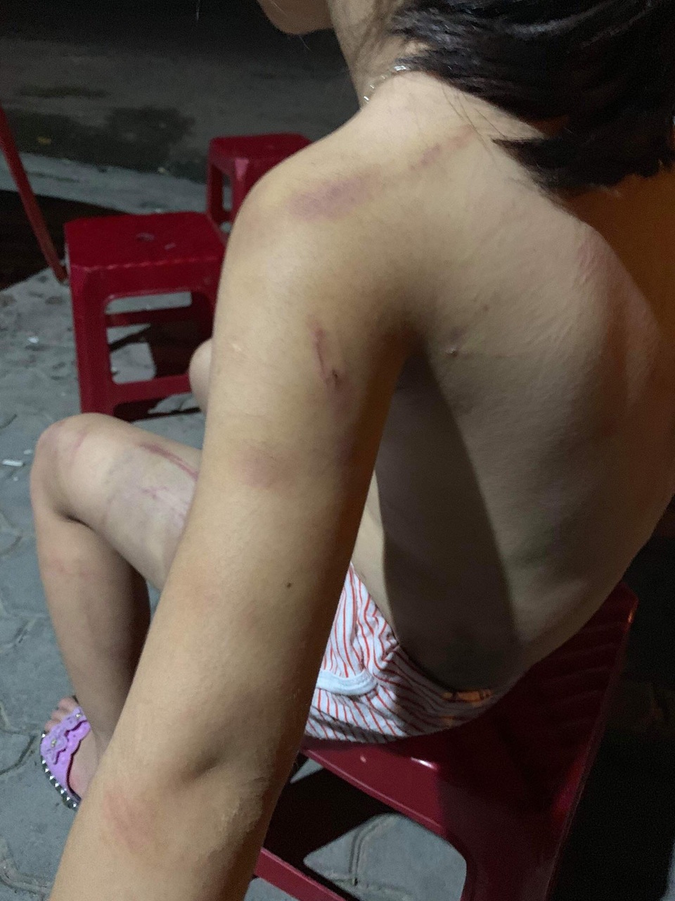 Cháu bé 6 tuổi ở Quảng Nam bị hành hạ Cháu bé 6 tuổi ở Quảng Nam bị hành hạ