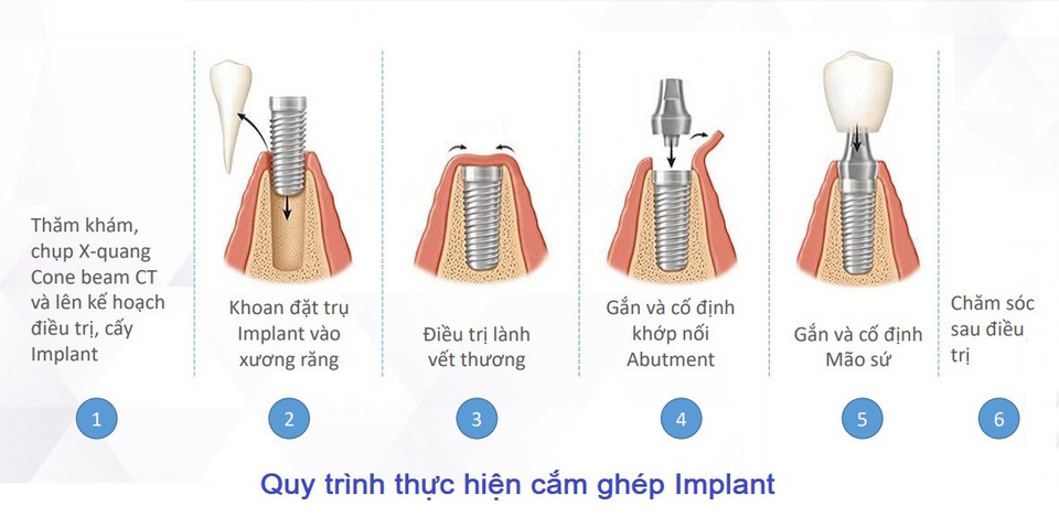 Loại trụ Implant nào tốt, “tuổi thọ” được bao lâu? - Ảnh 4. Loại trụ Implant nào tốt, “tuổi thọ” được bao lâu? - Ảnh 4.