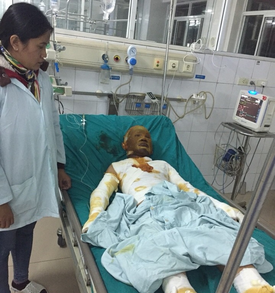 Hà Tĩnh: Cấp thẻ BHYT cho một học sinh bị bỏng nặng - Ảnh 1. Hà Tĩnh: Cấp thẻ BHYT cho một học sinh bị bỏng nặng - Ảnh 1.