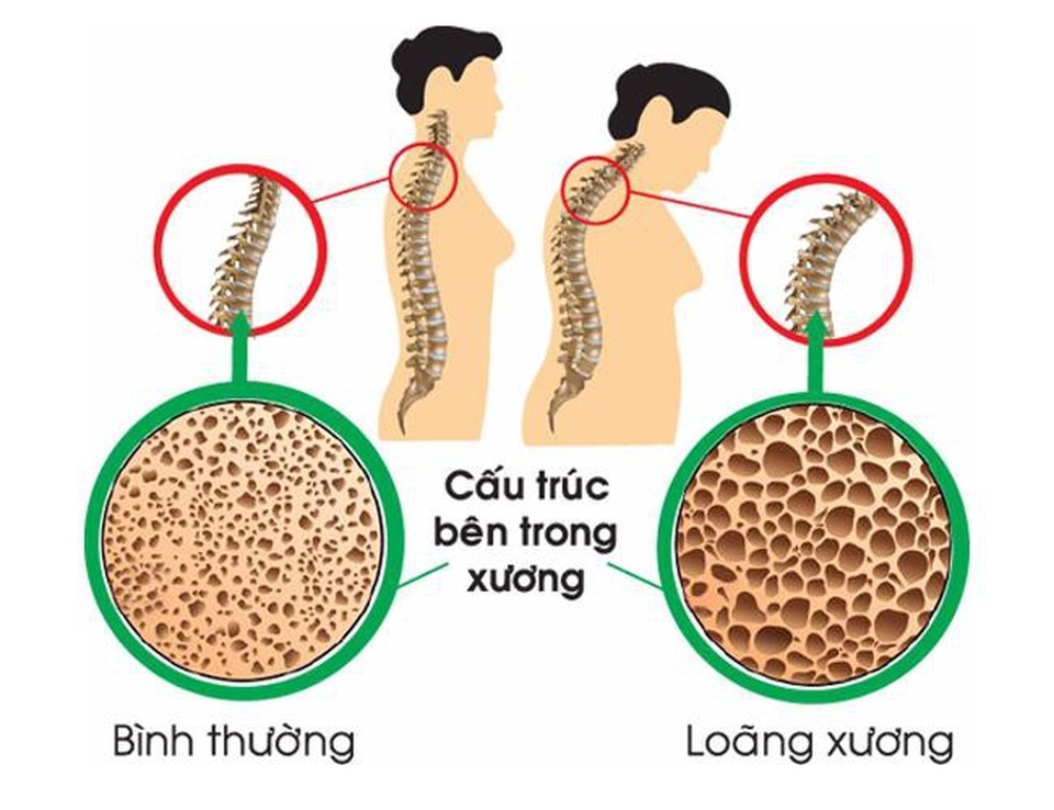 3 dấu hiệu cảnh báo cơ thể bạn đang thiếu canxi trầm trọng - Ảnh 1. 3 dấu hiệu cảnh báo cơ thể bạn đang thiếu canxi trầm trọng - Ảnh 1.