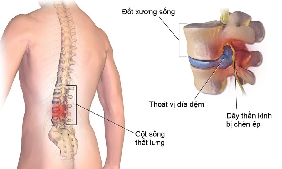 Thoát vị đĩa đệm – Nguyên nhân và giải pháp - Ảnh 1. Thoát vị đĩa đệm – Nguyên nhân và giải pháp - Ảnh 1.