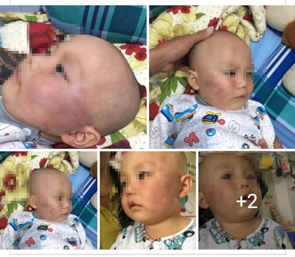 Bảo mẫu tát liên tiếp bé trai 19 tháng, nói dối là… ngã cầu thang - 1 Bé Huy bị đánh bầm má.