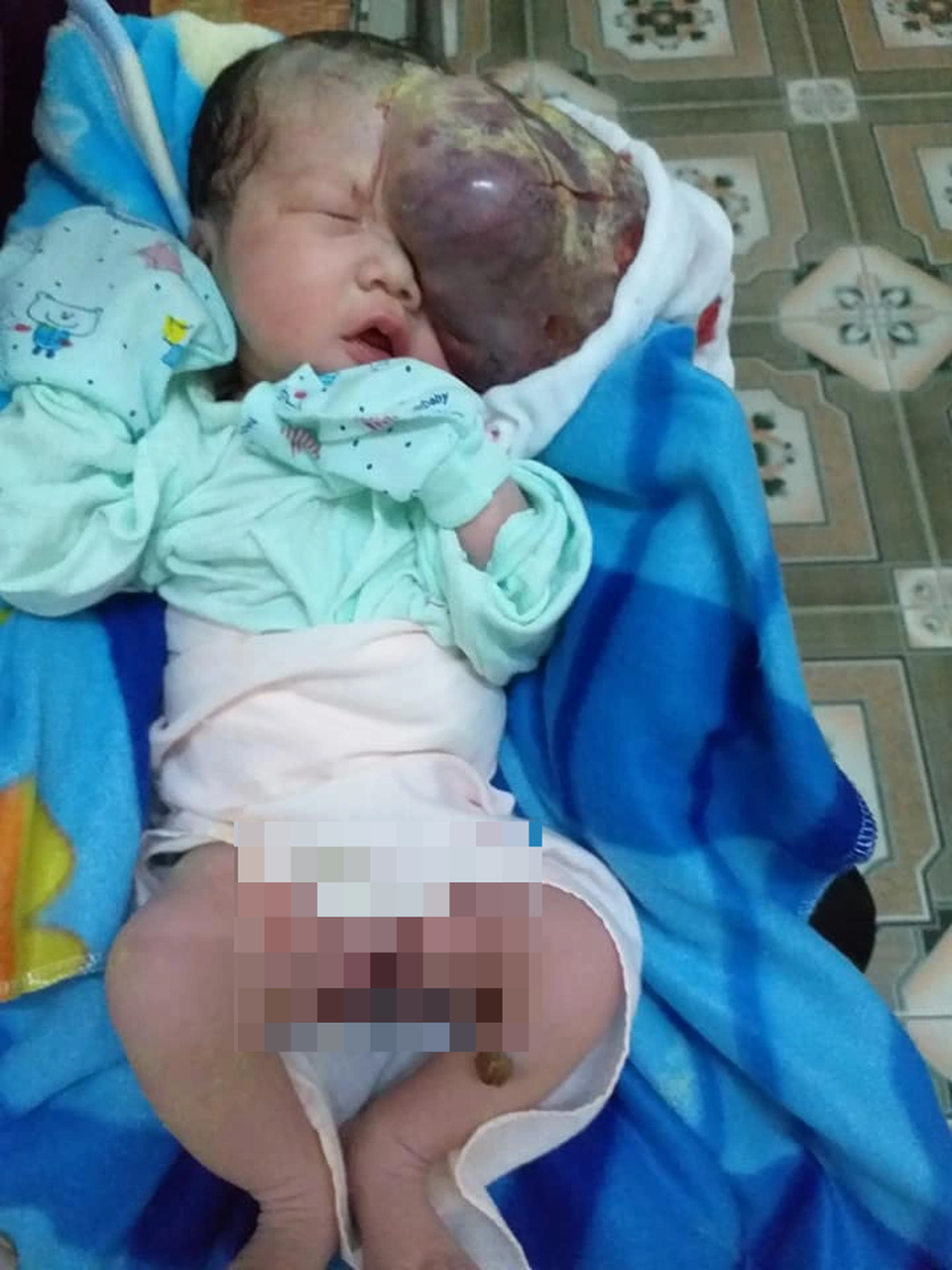 Mẹ chết ngất nhìn con chào đời mang u khủng dị thường trên mặt! - 8 Mẹ chết ngất nhìn con chào đời mang u khủng dị thường trên mặt! - 8