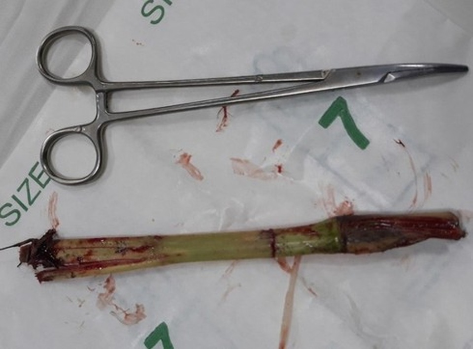 Bé trai bị cỏ voi đâm sâu 20cm trong da bụng khi chơi đùa - 1 Bé trai bị cỏ voi đâm sâu 20cm trong da bụng khi chơi đùa - 1