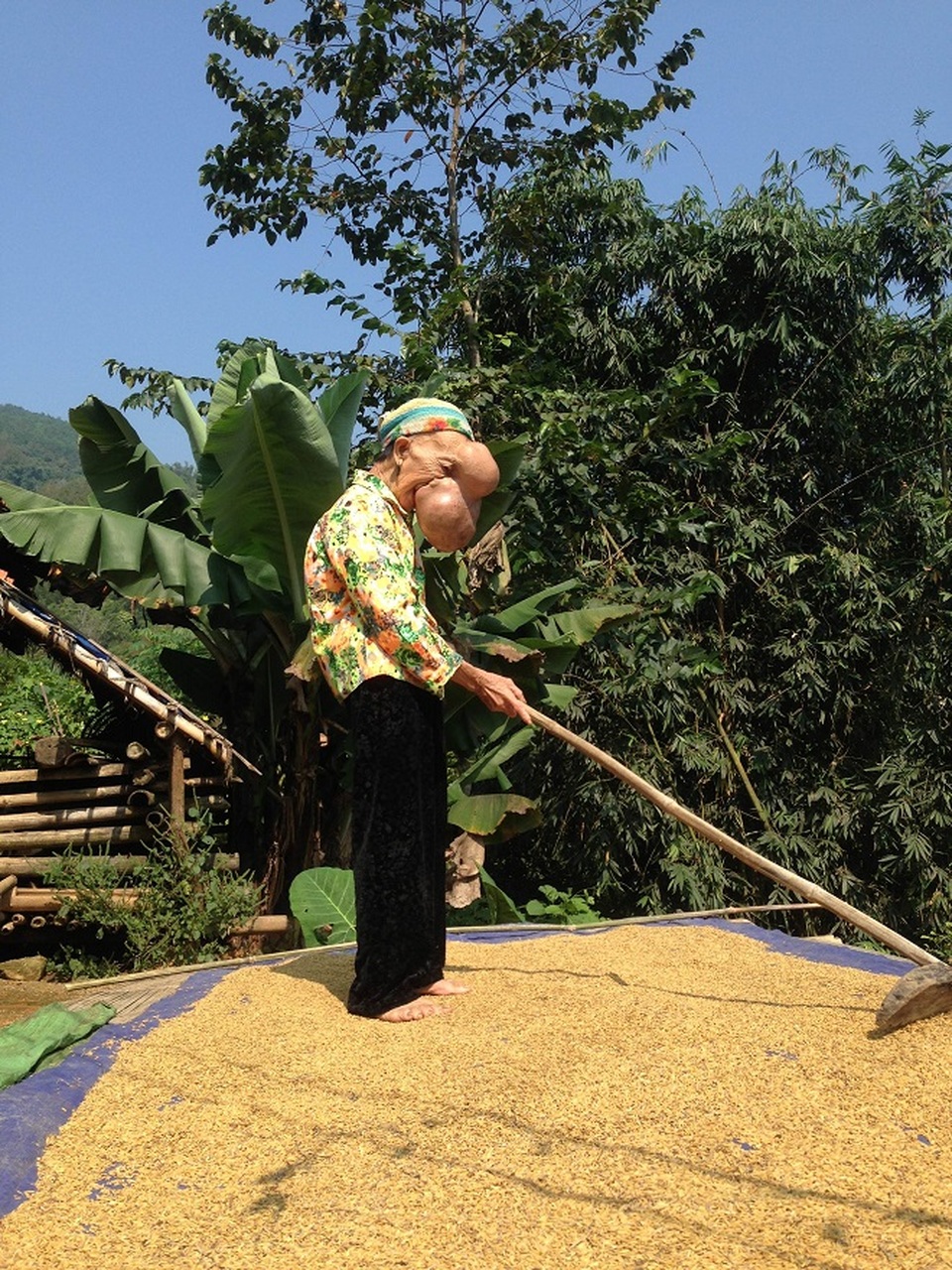 Mẹ chết ngất nhìn con chào đời mang u khủng dị thường trên mặt! - 10 Mẹ chết ngất nhìn con chào đời mang u khủng dị thường trên mặt! - 10