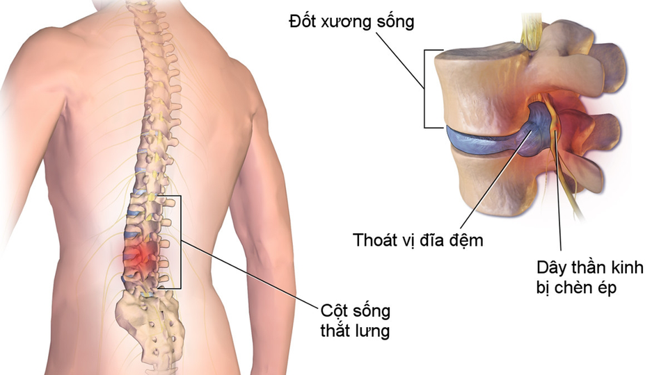 Khớp An Việt tác dụng như thế nào đối với bệnh xương khớp? - 2 Khớp An Việt tác dụng như thế nào đối với bệnh xương khớp? - 2