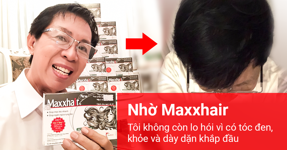 Chữa hói đầu sớm, rụng tóc nhiều: Biết trước điều này thật đáng giá biết bao nhiêu! - 4 Chữa hói đầu sớm, rụng tóc nhiều: Biết trước điều này thật đáng giá biết bao nhiêu! - 4