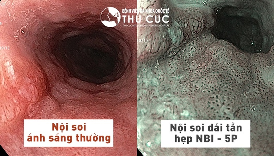 Phát hiện sớm ung thư đường tiêu hóa nhờ nội soi công nghệ NBI 5P - 1 Phát hiện sớm ung thư đường tiêu hóa nhờ nội soi công nghệ NBI 5P - 1