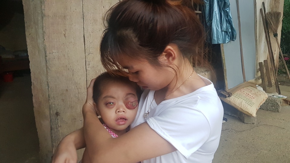 Bé gái có cặp mắt như quả bóng muốn nổ tung cầu cứu...! - 2 Bé gái có cặp mắt như quả bóng muốn nổ tung cầu cứu...! - 2