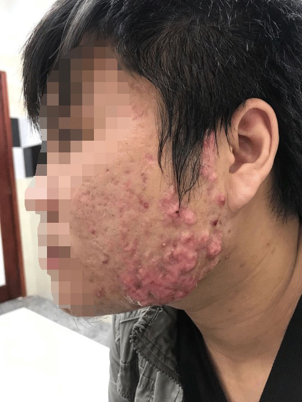 Dùng kháng sinh điều trị mụn trứng cá coi chừng… nát mặt - 2 Dùng kháng sinh điều trị mụn trứng cá coi chừng… nát mặt - 2