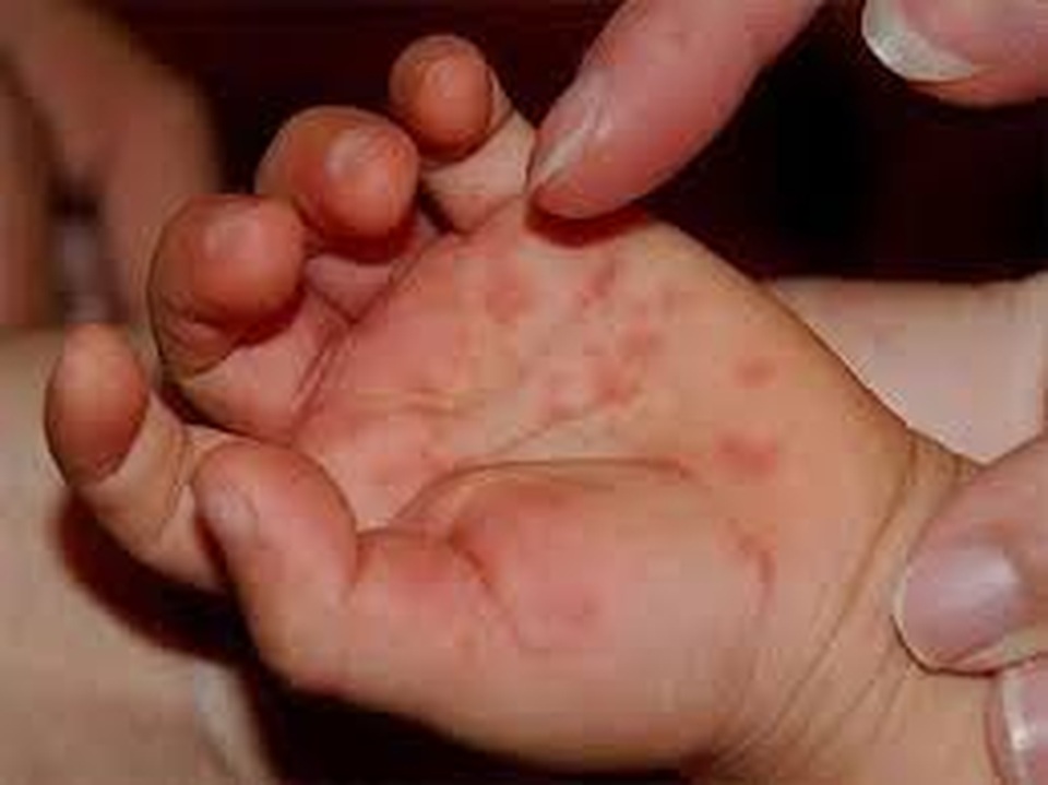 Thuốc chống virus “chữa khỏi” bệnh tay chân miệng? - 1 Thuốc chống virus “chữa khỏi” bệnh tay chân miệng? - 1